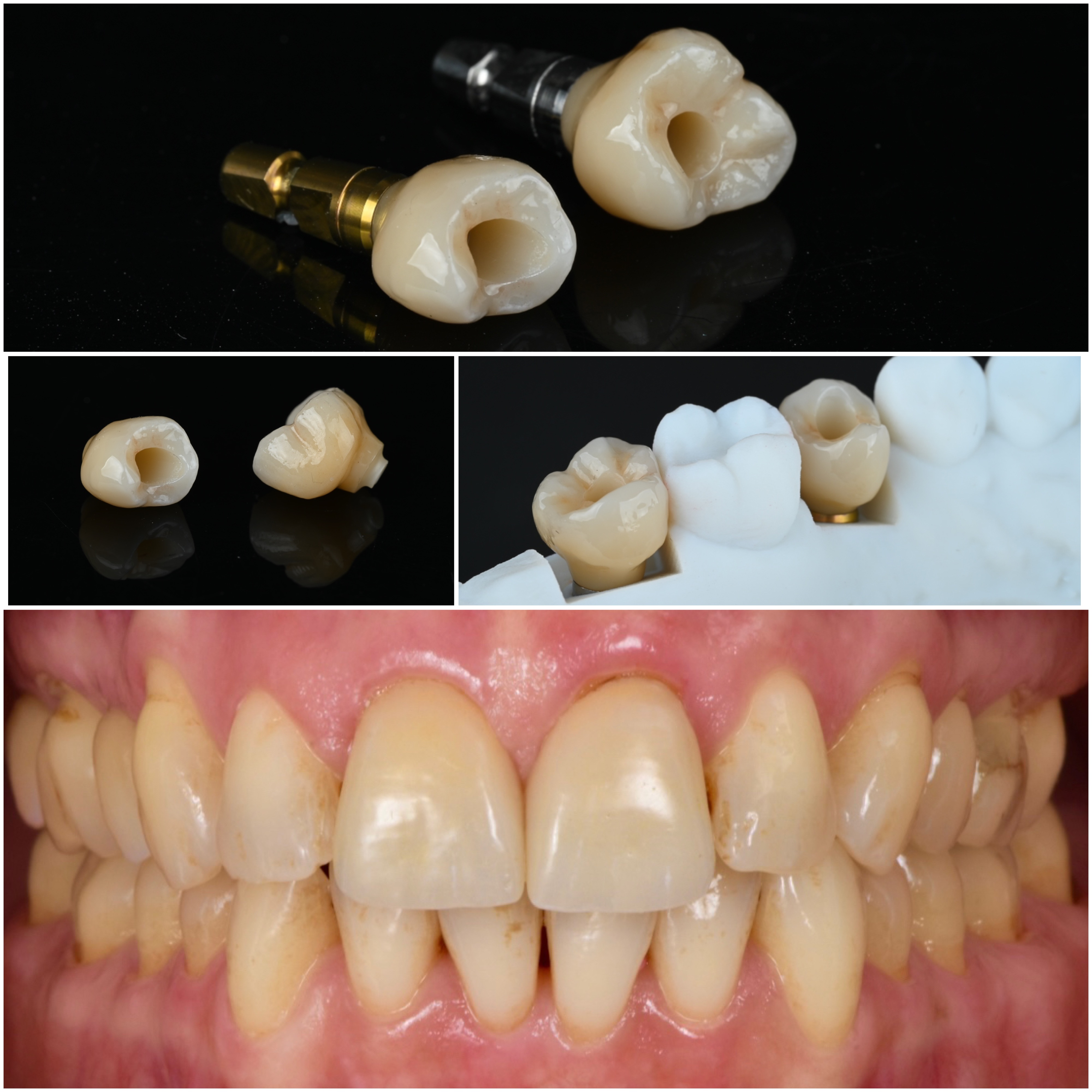 Zahnlux: Individuelle Implantat-Versorgung auf dem TRI Dental Implants System.