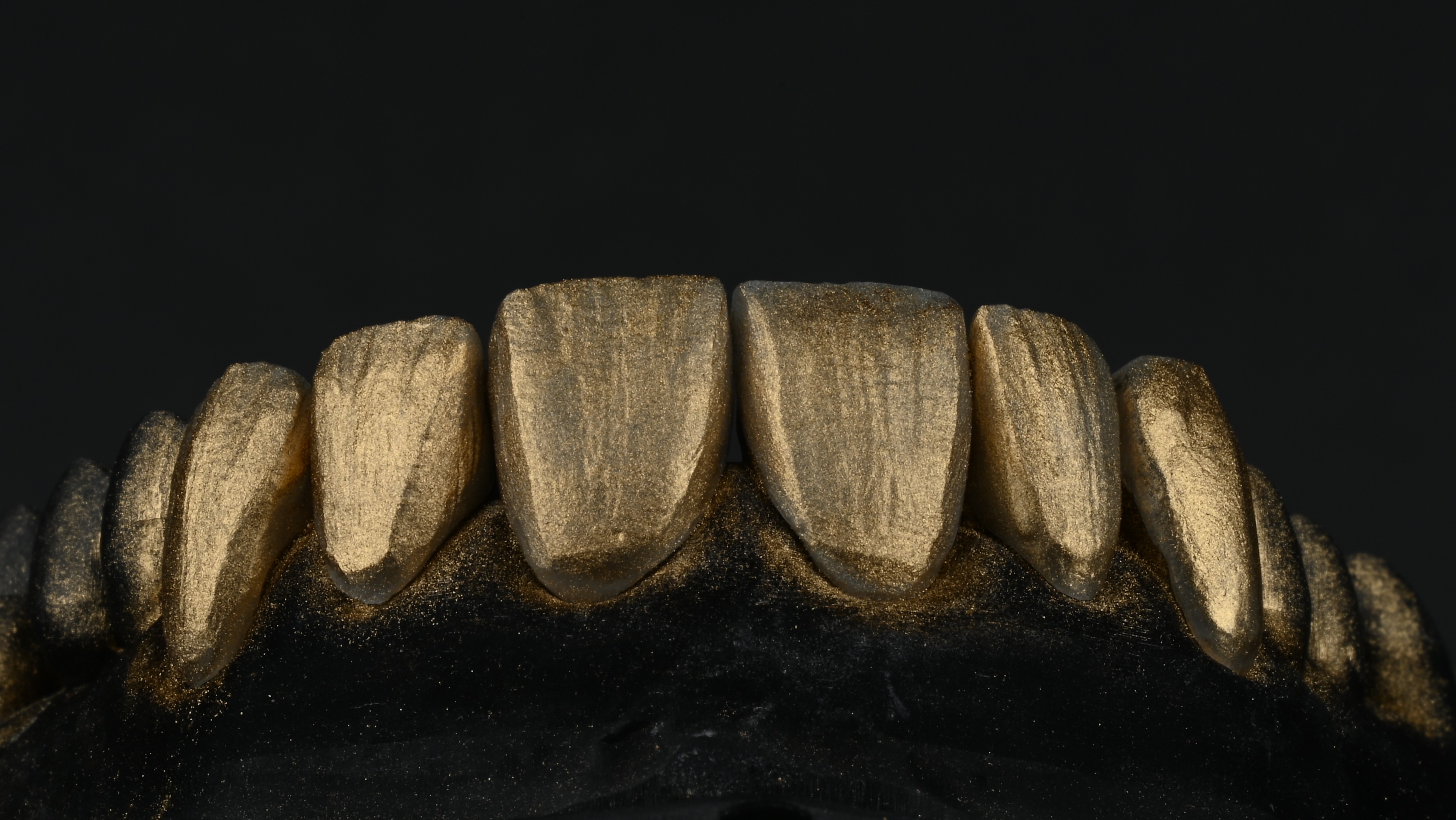 Hauchdünne E.max Veneers für ein natürliches Smile-Design von Zahnlux Zahntechnik.
